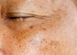 Treatment Options for Hyperpigmentation