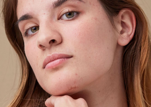 How to get rid of your acne scars for good